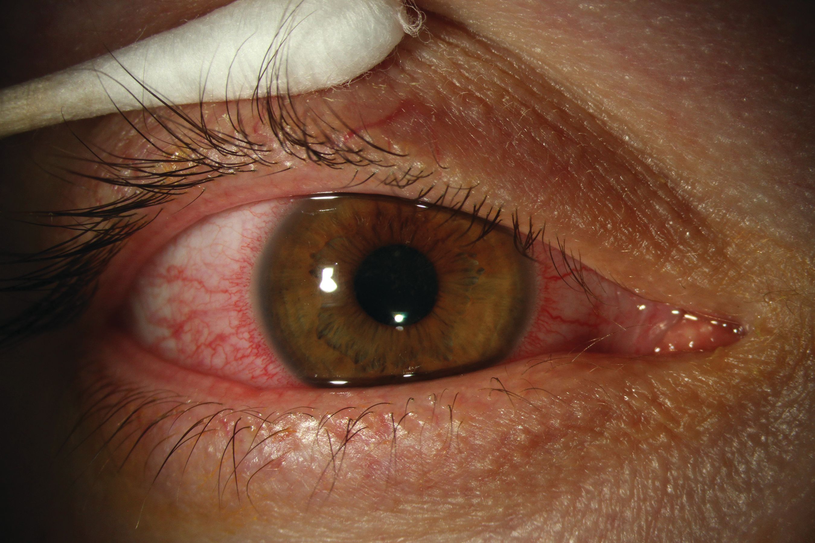 Dry Eye During High-Altitude Travel Dry Eye During High-Altitude Travel